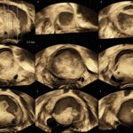 complex ovarian mass